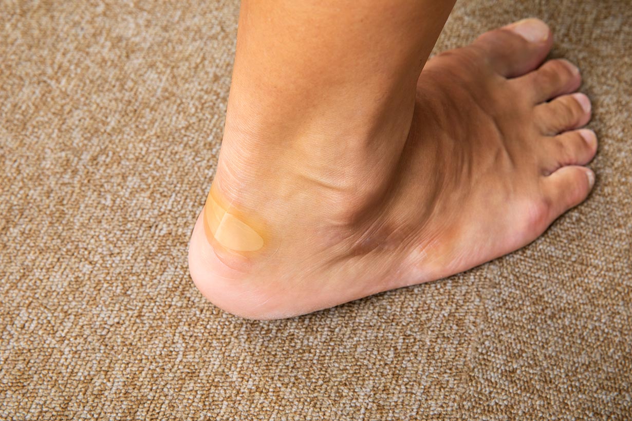 キズパワーパッドを貼ったところ